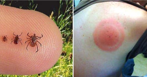 Saber identificar la picadura que causa la enfermedad de Lyme te puede salvar la vida