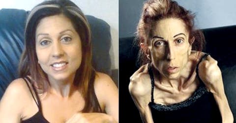 Sufría anorexia y pesaba 20 kilos pero por suerte logró una impresionante transformación