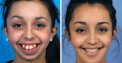 Una joven sufre una impresionante transformación tras 6 años de cirugías en su rostro