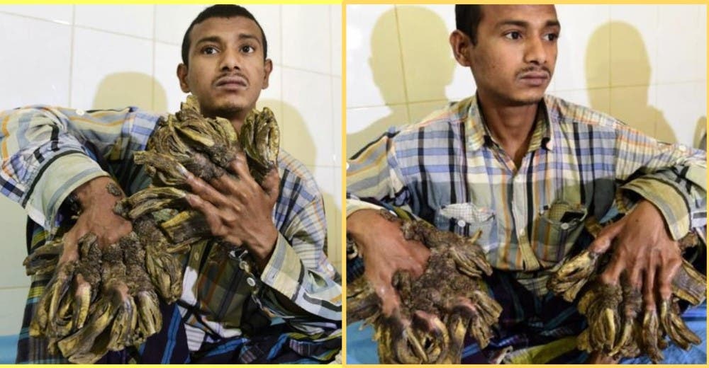 Después de 16 operaciones el «hombre árbol» por fin cumplirá el sueño de abrazar a su hija Después de 16 operaciones el «hombre árbol» por fin cumplirá el sueño de abrazar a su hija