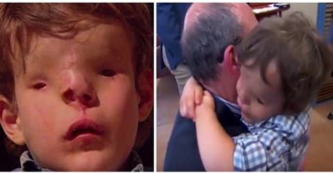 El pequeño que nació sin ojos ni parte de su nariz se aferra al médico que reconstruyó su rostro
