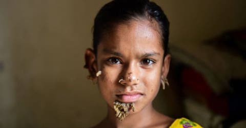 Una niña de Bangladesh es identificada como la primera «mujer árbol» del mundo