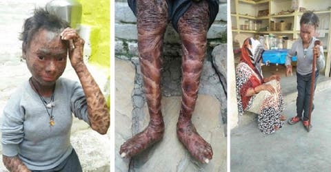 La llaman «la serpiente humana» por una extraña afección en su piel y necesita nuestra ayuda
