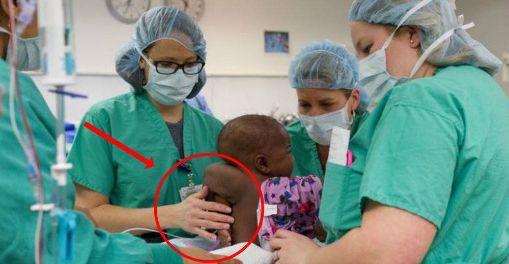 Operan a una bebé de 10 meses para extraer de su espalda los restos de su gemelo