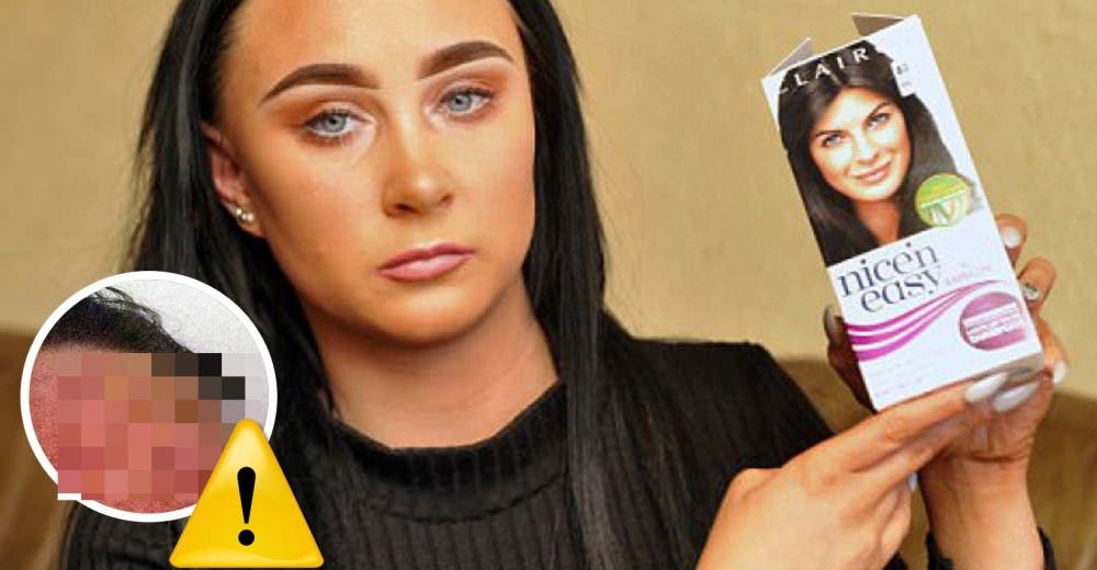 Estuvo luchando por su vida durante 2 semanas tras aplicarse un tinte para el cabello Estuvo luchando por su vida durante 2 semanas tras aplicarse un tinte para el cabello