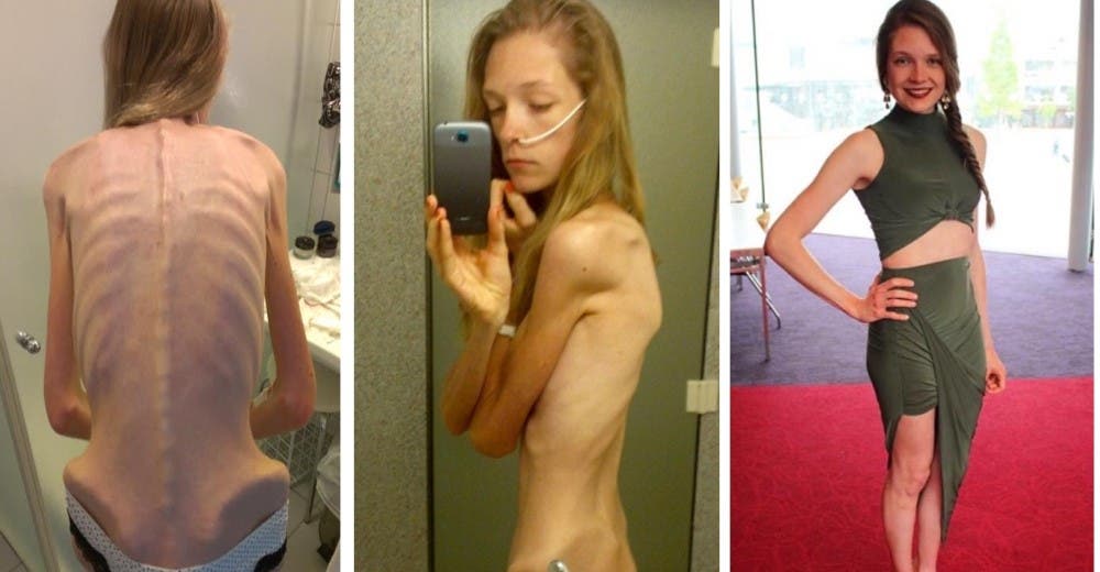 Hannah, la joven que estuvo al borde de la muerte y ahora inspira a otros contando su historia