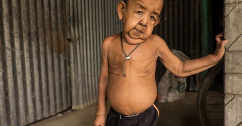 Bayezid tiene 4 años pero parece de 80, es el Benjamin Button de la vida real