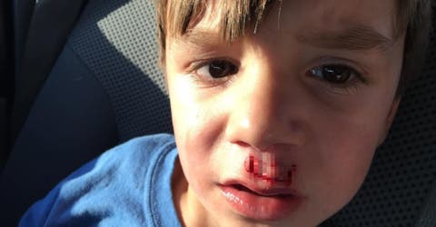 Alarmante – Un padre compartió la grave lesión que el juguete de moda le causó a su hijo