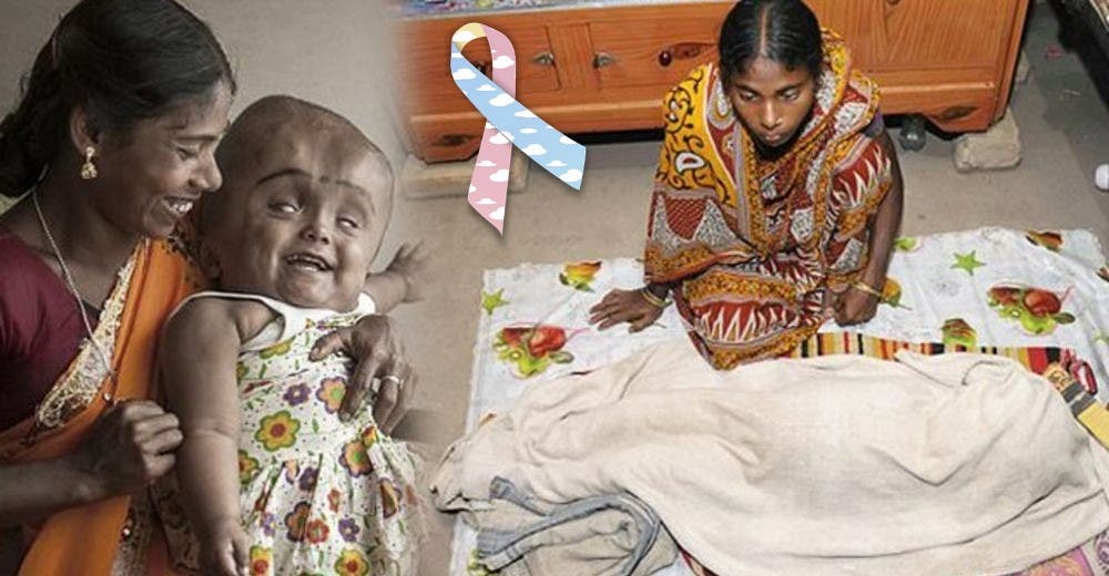 Tras 5 años de lucha, esta pequeña guerrera perdió la batalla contra la hidrocefalia