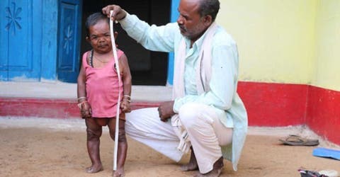 El impresionante caso de Basori Lal, un hombre de 50 años de edad que mide 74 centímetros