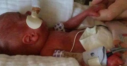 Billie, una bebé que nació pesando medio kilo a las 25 semanas y desafió todo pronóstico