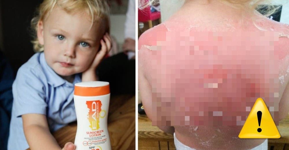 Utilizar este protector solar barato le costó muy caro a los padres de este niño de 3 años