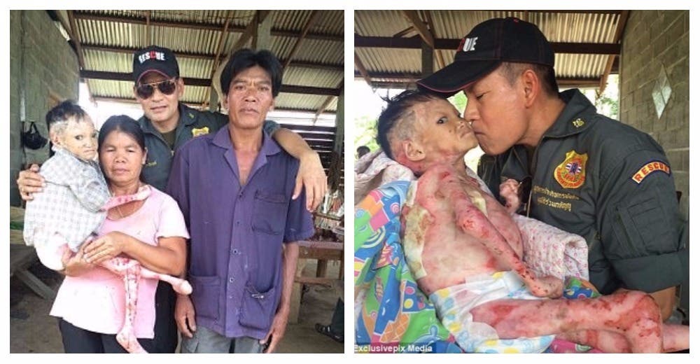 La desgarradora historia de Khewjira, la joven que lucha contra una terrible afección en su piel La desgarradora historia de Khewjira, la joven que lucha contra una terrible afección en su piel