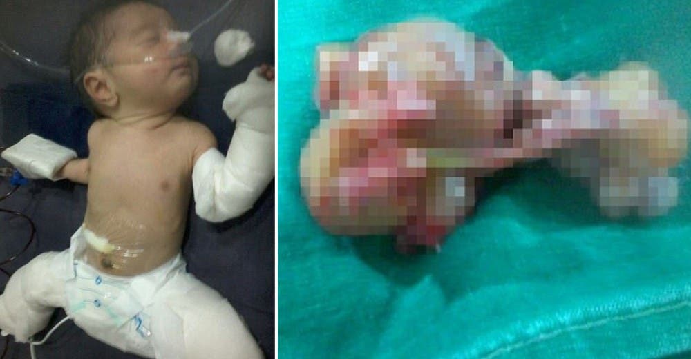 El nacimiento de este bebé «embarazado» de su hermano gemelo ha desconcertado a todos