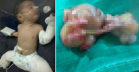 El nacimiento de este bebé «embarazado» de su hermano gemelo ha desconcertado a todos