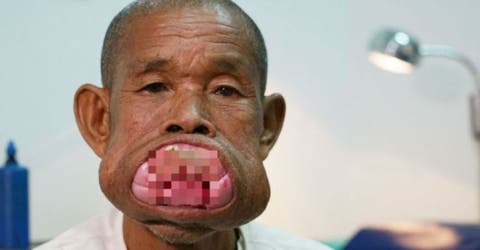 El extraño caso de Eng, un hombre que padeció 30 años con una rara afección en su boca