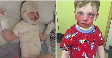 Compartió las fotos de las graves lesiones de su hijo para salvar a otros del mismo accidente
