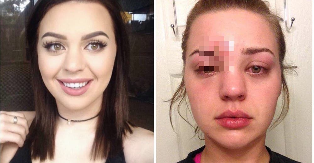 Nunca pensó que una «gran espinilla» en su rostro pondría en peligro su vida – Advertencia Nunca pensó que una «gran espinilla» en su rostro pondría en peligro su vida – Advertencia