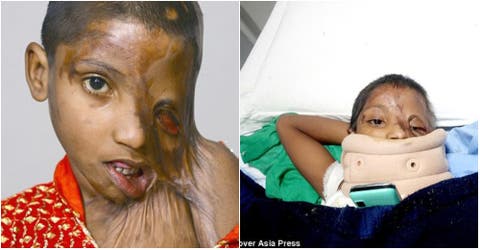 El calvario de una niña de 7 años que fue víctima de un ataque de ácido a manos de su padre