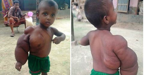 Shakiba, una niña de 2 años que lucha contra una extraña y dura enfermedad