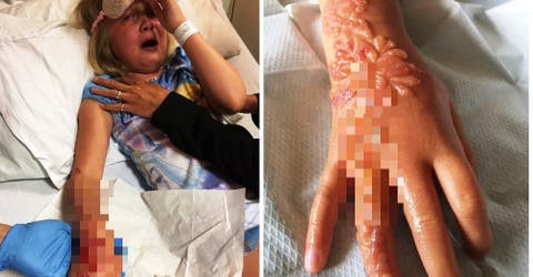 Madison, de 7 años, sufre una horrible agonía desde que le colocaron un tatuaje de «henna»