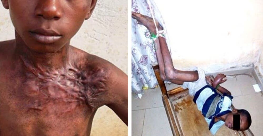 El padre de este niño de 13 años lo sometió a las más horribles torturas porque «era brujo»