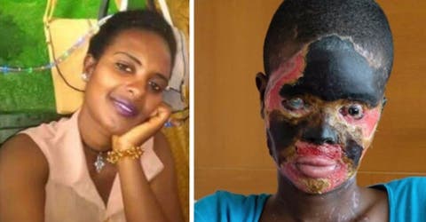 Su esposo la sorprendió arrojando ácido sobre su rostro mientras su hijo de 5 años dormía