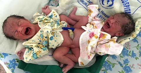 Una mujer de 32 años huye del hospital tras dar a luz a siameses unidos por la pelvis