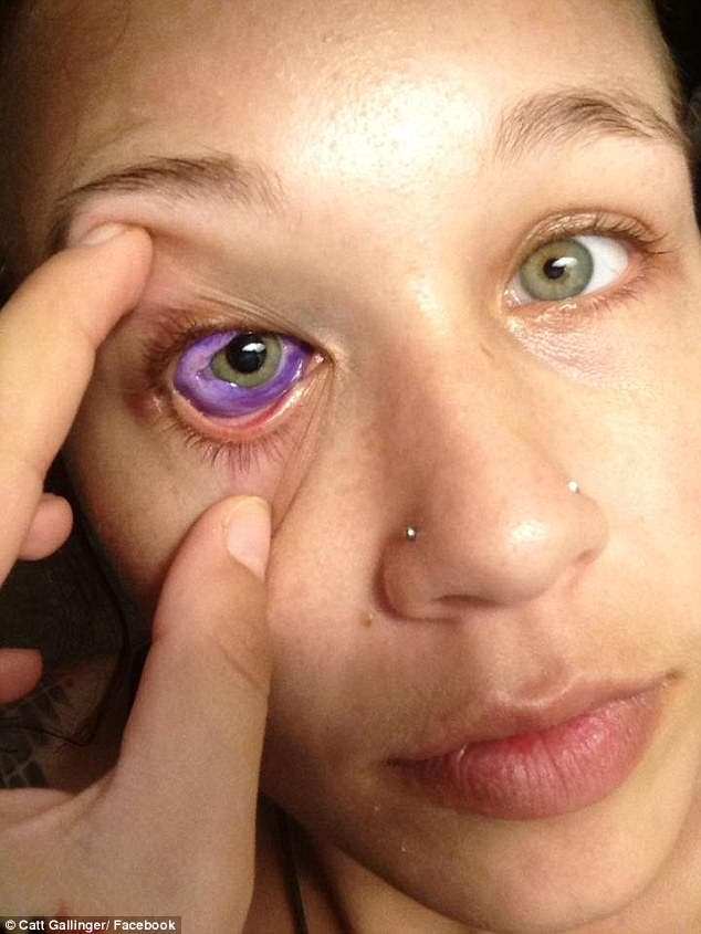 Catt Gallinger canada ottawa tatuaje ojo pierde vista tuerta infección tattoo loses sight sclera esclera parte blanca tinta morada