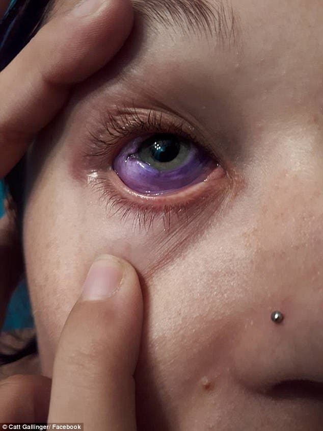 Catt Gallinger canada ottawa tatuaje ojo pierde vista tuerta infección tattoo loses sight sclera esclera parte blanca tinta morada