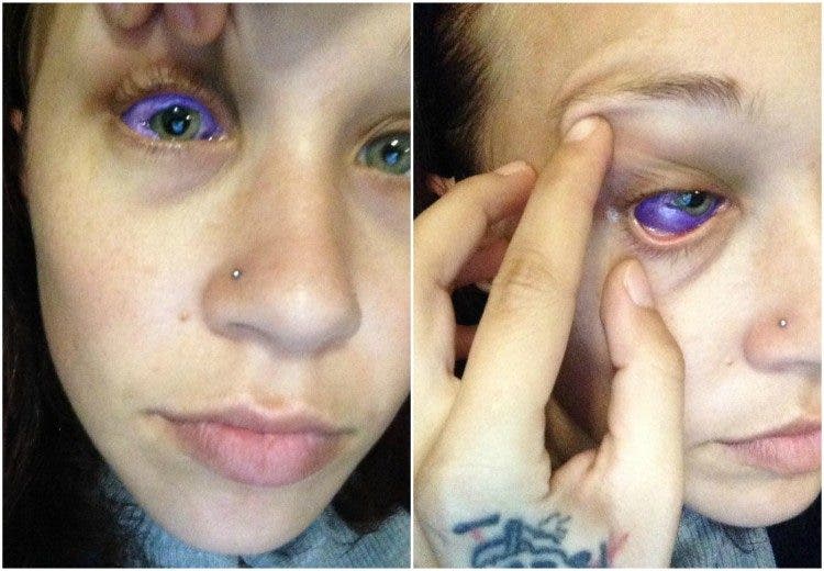 Catt Gallinger canada ottawa tatuaje ojo pierde vista tuerta infección tattoo loses sight sclera esclera parte blanca tinta morada