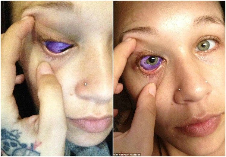 Catt Gallinger canada ottawa tatuaje ojo pierde vista tuerta infección tattoo loses sight sclera esclera parte blanca tinta morada