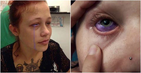 Catt Gallinger canada ottawa tatuaje ojo pierde vista tuerta infección tattoo loses sight sclera esclera parte blanca tinta morada