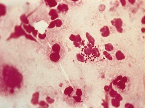 gonorrea enfermedad trasmision sexual imposible tratar resistente antibioticos supervirus mas fuerte 