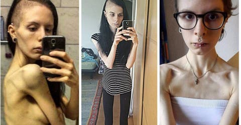 Para ocultar su anorexia, Julia escondía la comida dentro de sus orejas y en su cabello