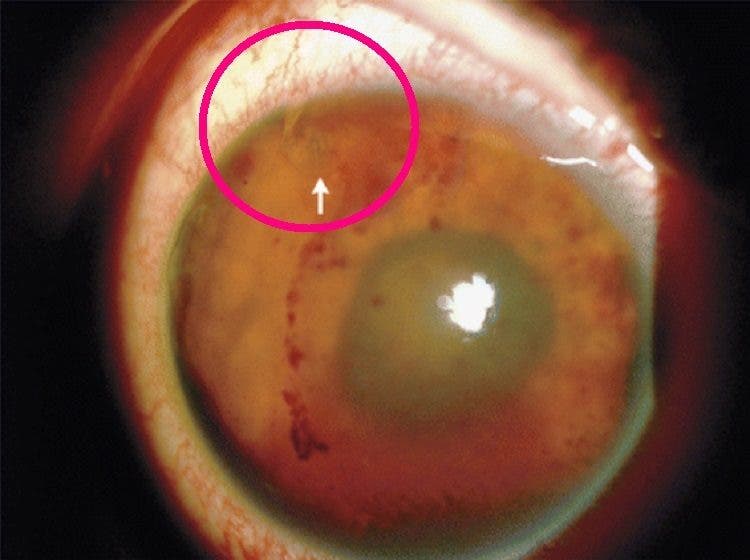 asqueroso horrible un gusano infecto el ojo de un joven es un caso muy raro video que muestra el parasito moviendose dentro del ojo parasite eye iiris infection rare extraordinary