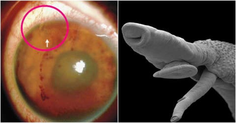 asqueroso horrible un gusano infecto el ojo de un joven es un caso muy raro video que muestra el parasito moviendose dentro del ojo parasite eye iiris infection rare extraordinary