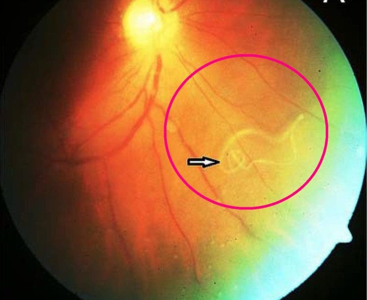 asqueroso horrible un gusano infecto el ojo de un joven es un caso muy raro video que muestra el parasito moviendose dentro del ojo parasite eye iiris infection rare extraordinary