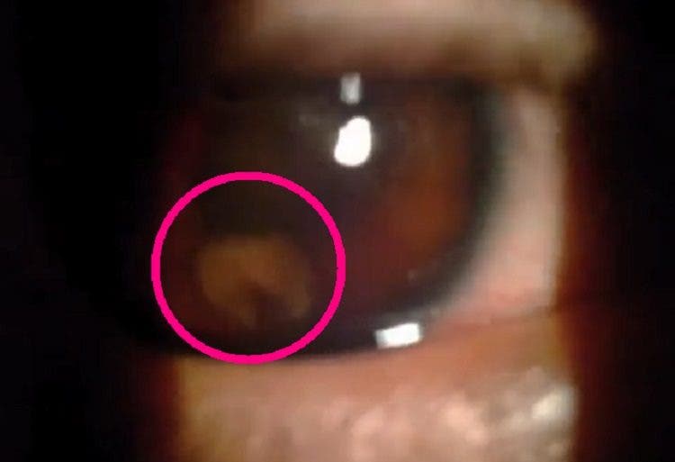 asqueroso horrible un gusano infecto el ojo de un joven es un caso muy raro video que muestra el parasito moviendose dentro del ojo parasite eye iiris infection rare extraordinary