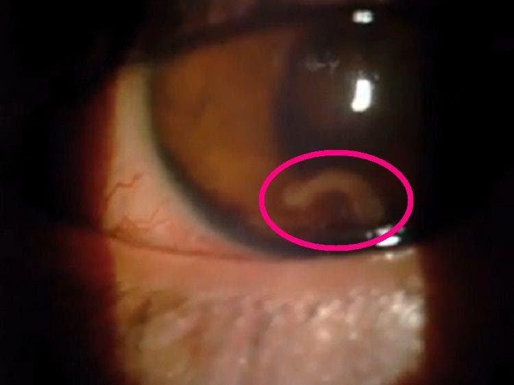 asqueroso horrible un gusano infecto el ojo de un joven es un caso muy raro video que muestra el parasito moviendose dentro del ojo parasite eye iiris infection rare extraordinary