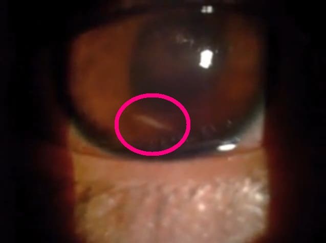 asqueroso horrible un gusano infecto el ojo de un joven es un caso muy raro video que muestra el parasito moviendose dentro del ojo parasite eye iiris infection rare extraordinary