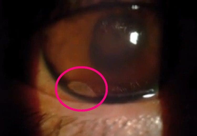 asqueroso horrible un gusano infecto el ojo de un joven es un caso muy raro video que muestra el parasito moviendose dentro del ojo parasite eye iiris infection rare extraordinary