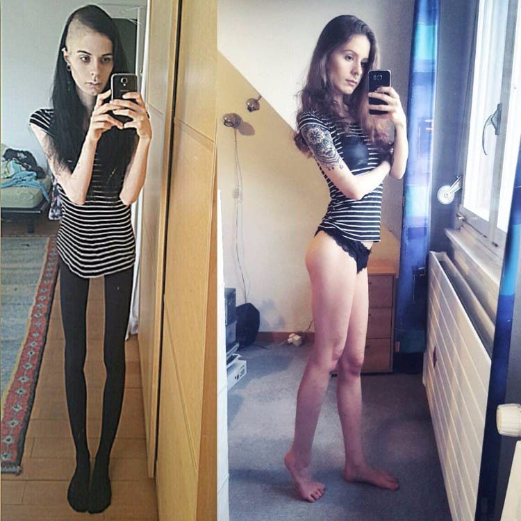 Modelos diagnosticadas con anorexia ya no podrán desfilar en Francia | Noticias RCN