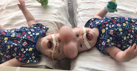 Después de un año de espera y 23 cirugías finalmente separan a unas hermanas siamesas