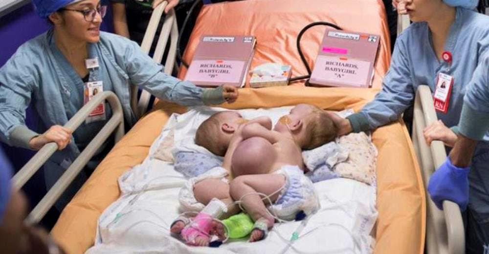 Una complicada cirugía les devuelve la esperanza a estas hermanas siamesas – EMOTIVO Una complicada cirugía les devuelve la esperanza a estas hermanas siamesas – EMOTIVO