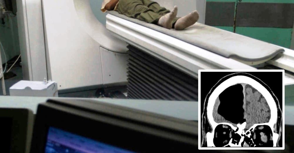 Los médicos se quedan perplejos al ver que su paciente tenía «medio cerebro vacío» Los médicos se quedan perplejos al ver que su paciente tenía «medio cerebro vacío»