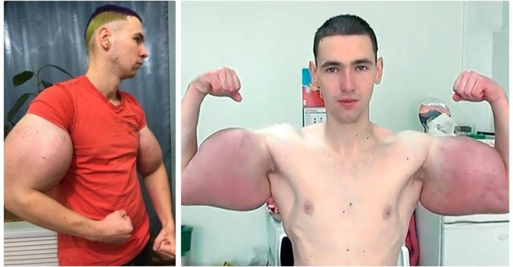 «Pido a Dios irme al cielo»-El ‘hulk’ ruso dice que ya no soporta el intenso dolor de sus brazos «Pido a Dios irme al cielo»-El ‘hulk’ ruso dice que ya no soporta el intenso dolor de sus brazos