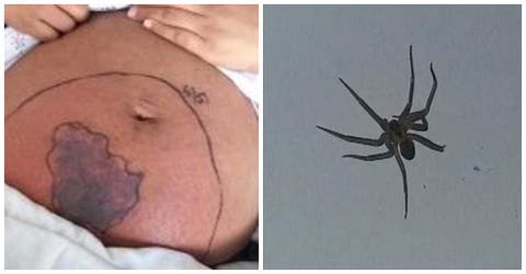 Estaba embarazada de 7 meses cuando una araña venenosa la mordió justo donde crecía su bebé