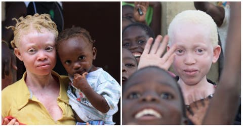 Creencias asesinas: un «juego completo» de huesos de albino puede costar 60.000 euros en África