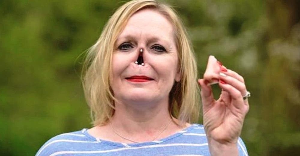 Perdió por completo su nariz, pero recibió una prótesis que le ha cambiado la vida